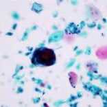 liquid phase cytology